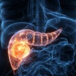 Novo remédio contra câncer de pâncreas anima oncologistas